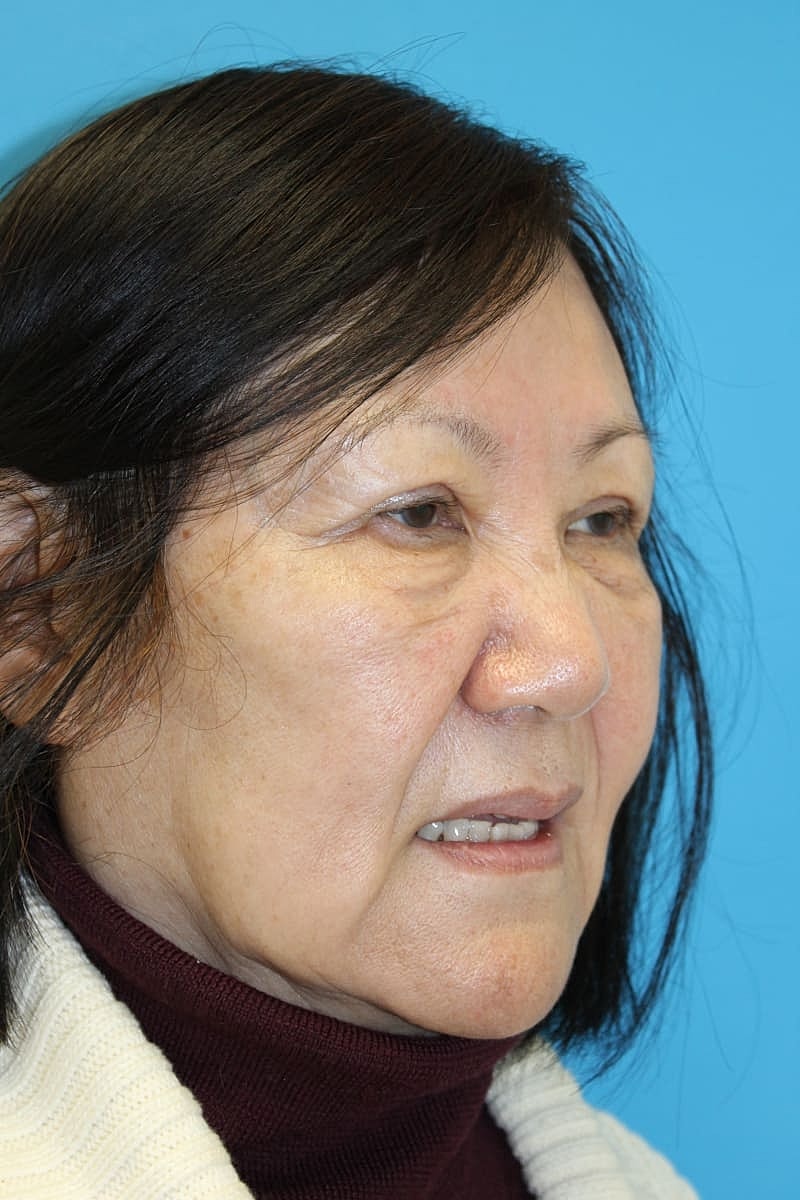 Upper Blepharoplasty Before & After