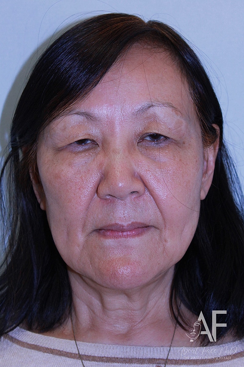 Upper Blepharoplasty Before & After