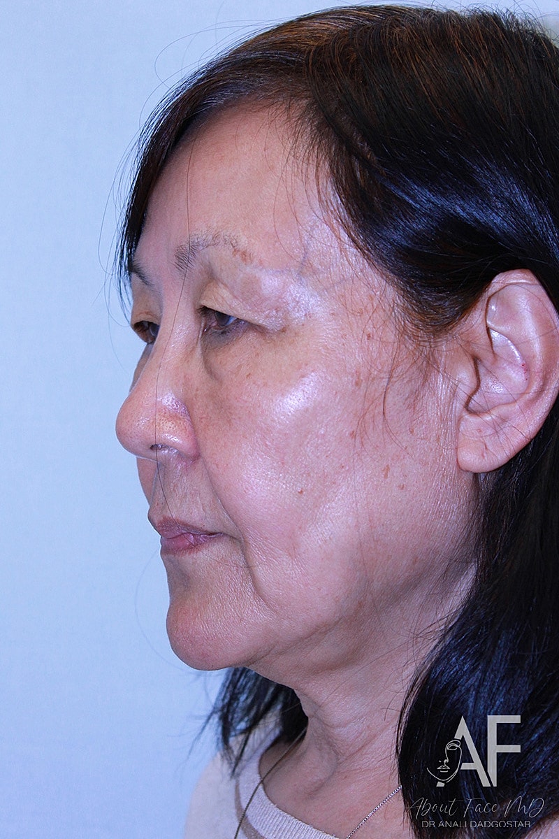 Upper Blepharoplasty Before & After